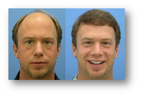hair-transplant-cost